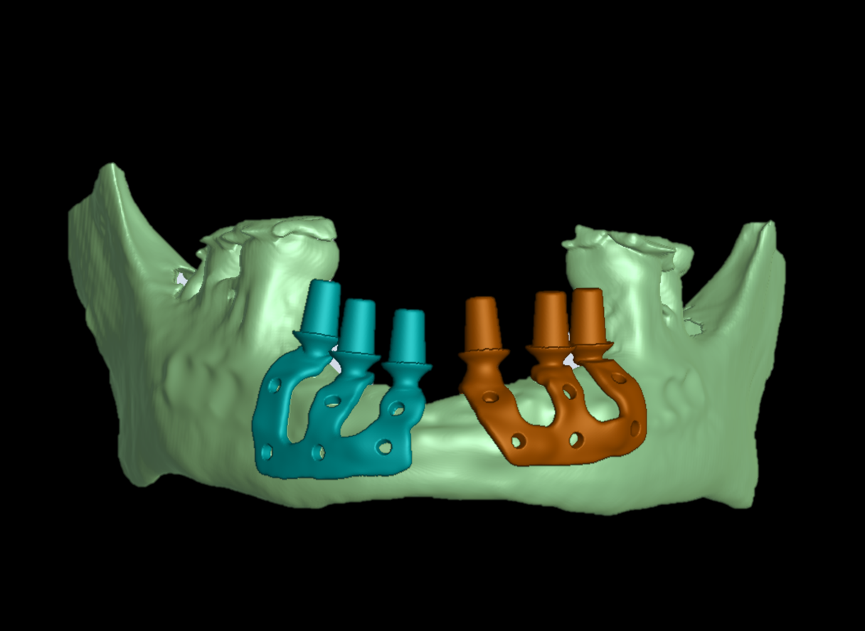 Sub-Periosteal Implant