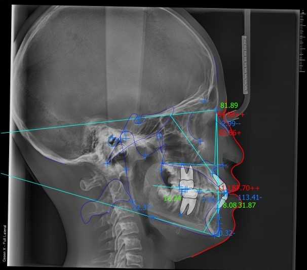 Cephalometric Analysis 2D