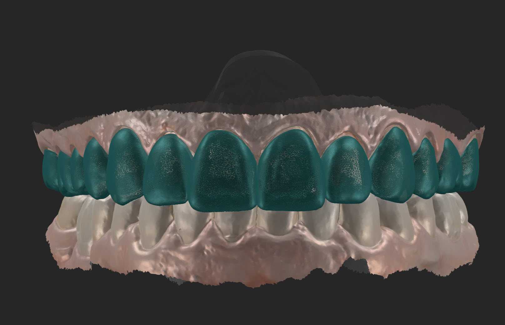 3D Digital Smile Design