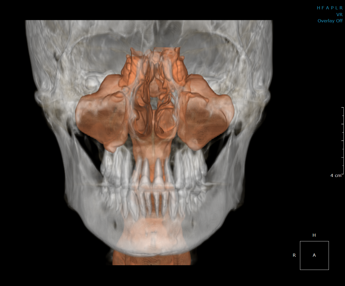 Maxillary Sinus/Airway Portfolio