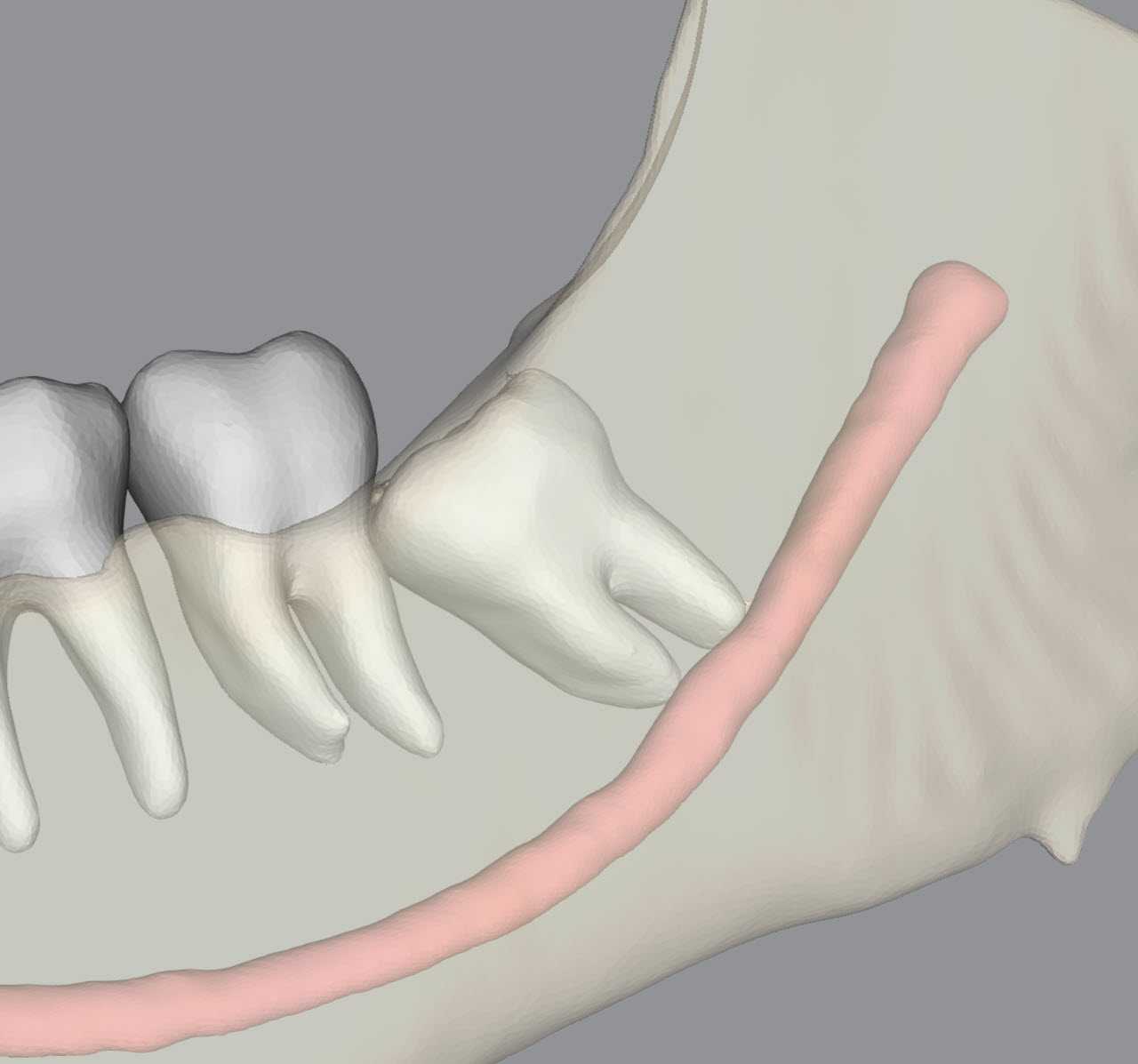 Impaction CBCT Portfolio